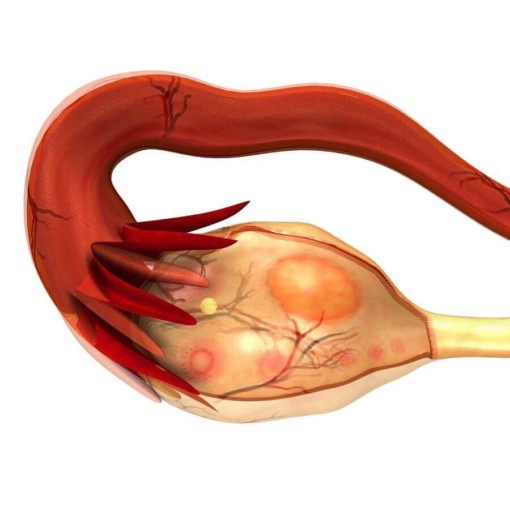 Erkennt den wie eisprung man Anovulation (fehlender