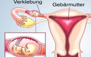 Nach Eileiterschwangerschaft IVF oder ICSI